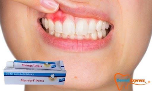 Gel bôi nướu metrogyl denta