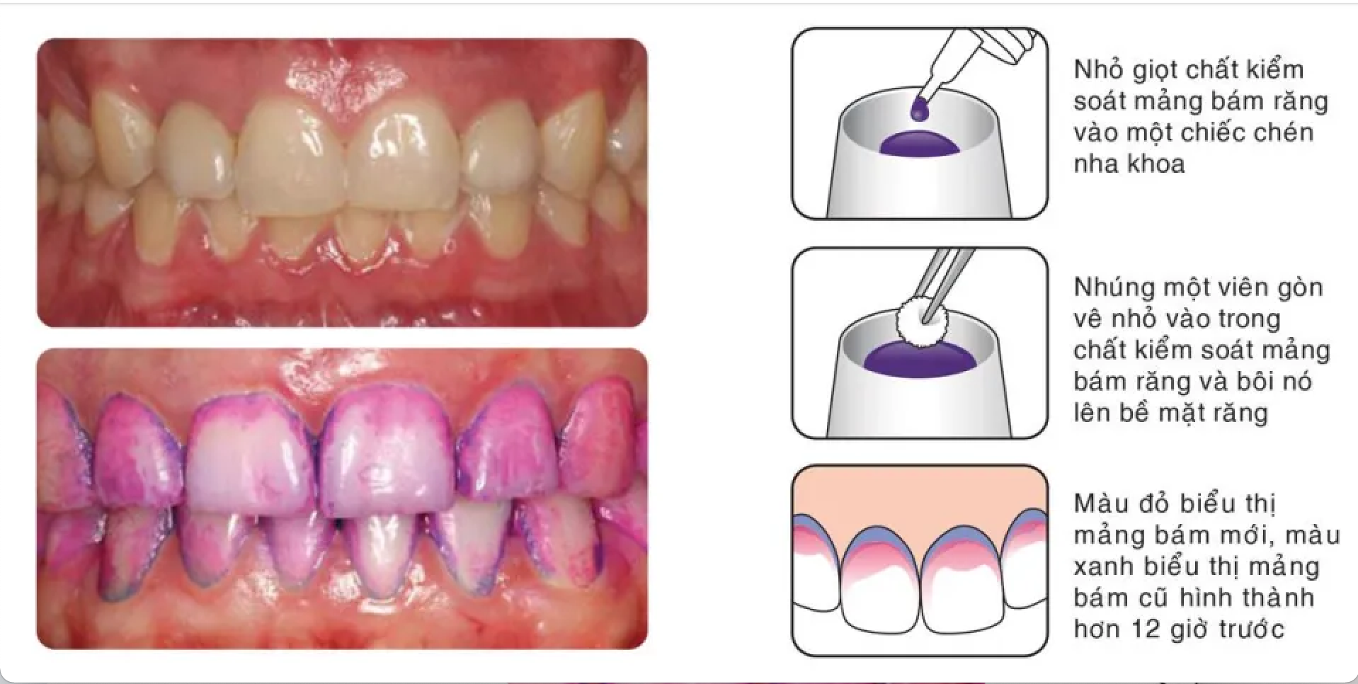 Chất kiểm soát mảng bám chỉ thị Tepe plaqsearch 