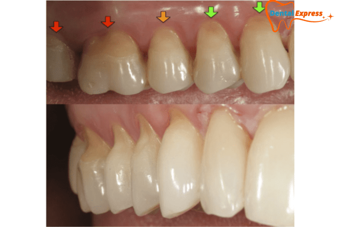 Phục hồi mòn cổ răng